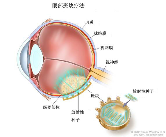 【眼内(葡萄膜 黑色素瘤治疗】治疗方案_分期疗法-nci指南