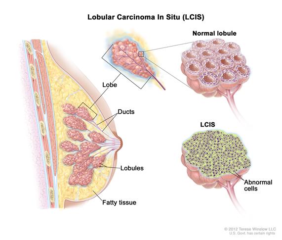 (小叶原位癌(lcis).异常细胞见于乳腺小叶.