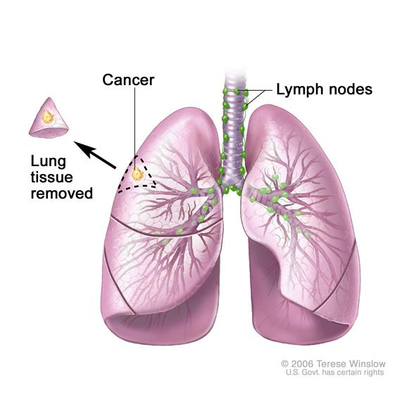 tissue removed 切除的肺组织,lymph nodes 淋巴结)  肺部楔形切除术