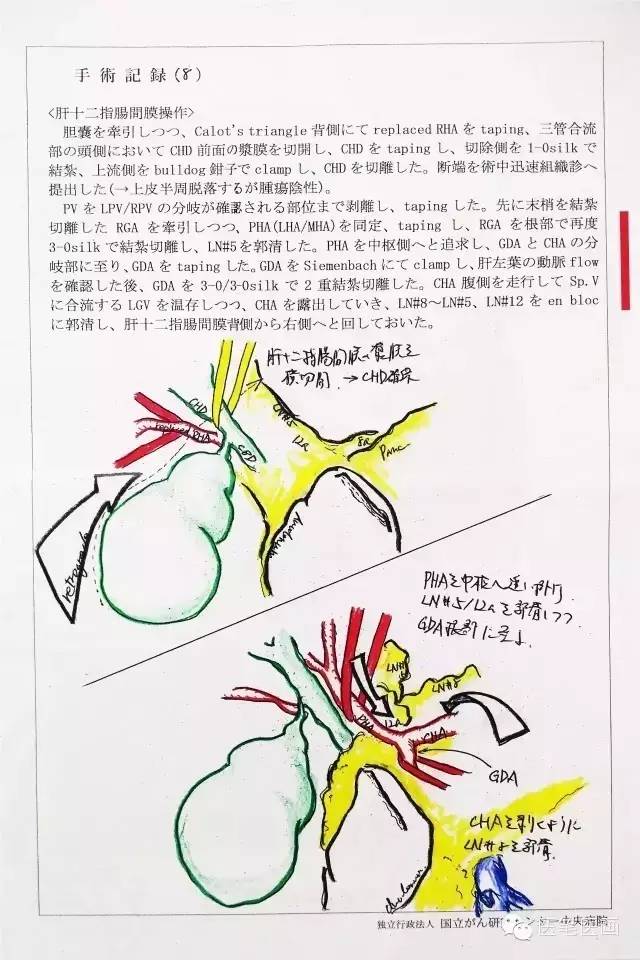9.肝管-空肠吻合。 将空肠残端从横结肠系膜裂孔处提至肝下方,距空肠残端约15cm处切开空肠,置入5Fr导管从残端引出,5-0PDS缝线行肝管空肠吻合(后壁7针,前壁5针),4-0Vicryl Rapide缝线固定导管,导管内注入空气测试胆瘘(-)。 10.胰-胃吻合。 胃体下部后壁切开约4cm备吻合。胰腺残端找出胰管,插入5Fr胰管支架,用4-0Vicryl Rapide缝线固定。3-0ProleneTE缝线3针法行胰胃吻合。B超确认套入的胰腺残端及胰管支架在位。
