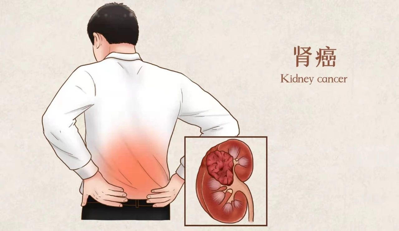 50%患者无症状,发现即中晚期?肾癌这七种潜在风险你