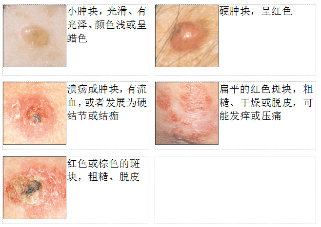 皮肤癌判断图片图片