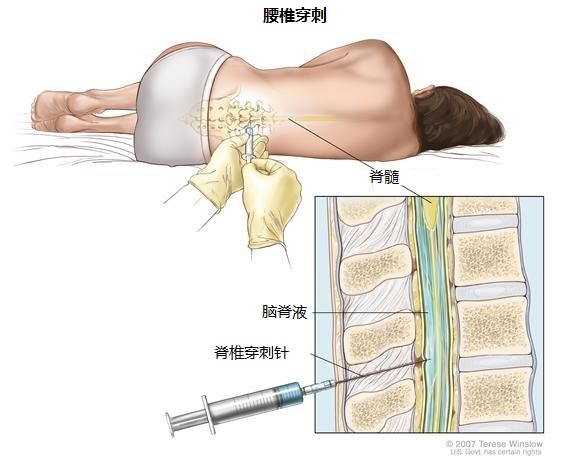 腰椎穿刺:用于采集脊柱中的脑脊液的过程,通过将一根针插入脊柱完成