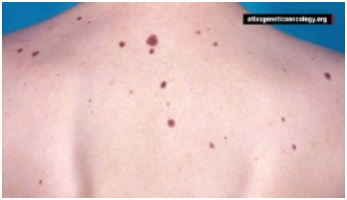 什么是黑色素瘤病 6360842555783036981011153.png