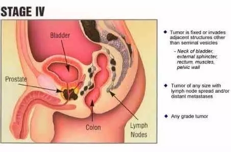 什么是基因突变的肿瘤 6363063407514377319817272.jpg