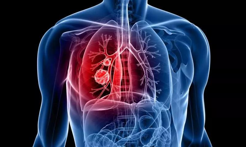 这项研究使转移性肺癌生存期延长3倍！.jpg