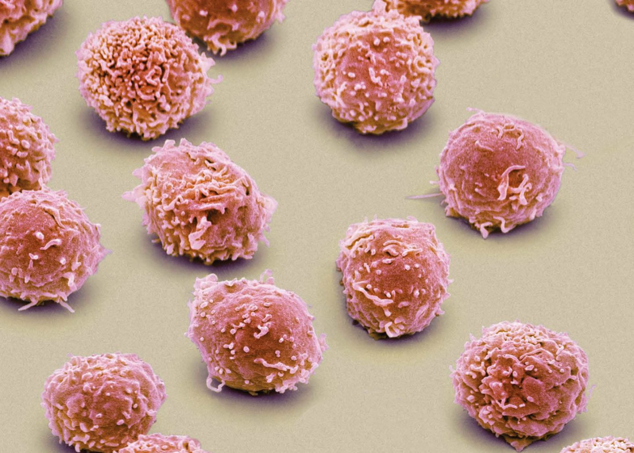 93有效67完全缓解cart对套细胞淋巴瘤研究结果喜人