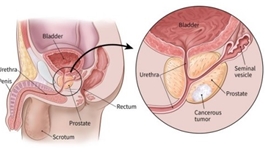 前列腺癌新的研究進展（三）