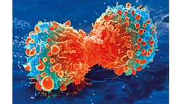 研究显示：新辅助联合免疫疗法可改善早期非小细胞肺癌的预后