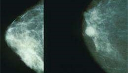 梅奧乳腺影像學專家討論致密型乳腺與分子乳腺成像
